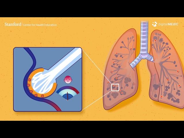 How COVID-19 Makes Breathing Difficult