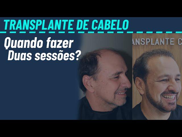 Transplante capilar em calvície grande precisa de duas sessões