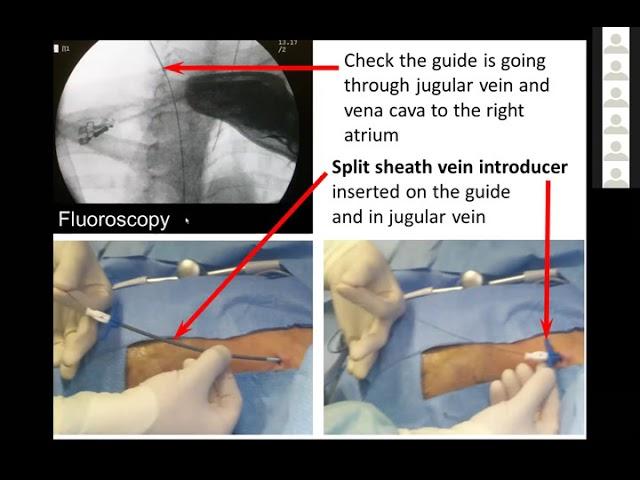 Stephane Goutagny MD Neurosurgeon: "Ventriculo-atrial Shunting"