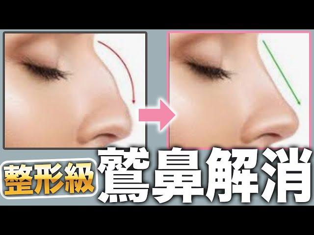 Elimination of eagle nose nasal muscle nasal bone self-care