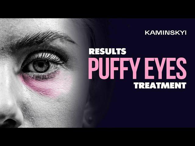 Puffy eyes. Analysis, result, recovery and rehabilitation / KAMINSKYI