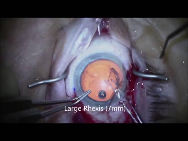 Narrated IMT Surgical Procedure by Sumit Garg MD