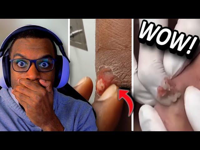 DO YOU SEE THE SIZE OF THAT CYST?!