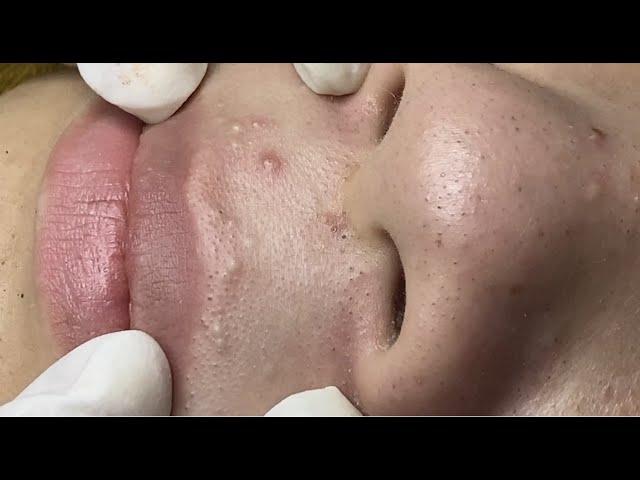 Acne treatment for Nguyen (P3) #HoangMySpa67