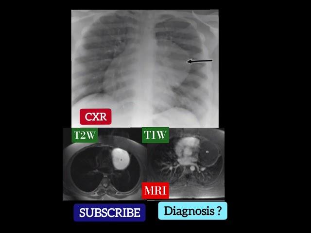 Diagnosis ? CXR & MRI T1W & T2W - Practical Case - Radiology