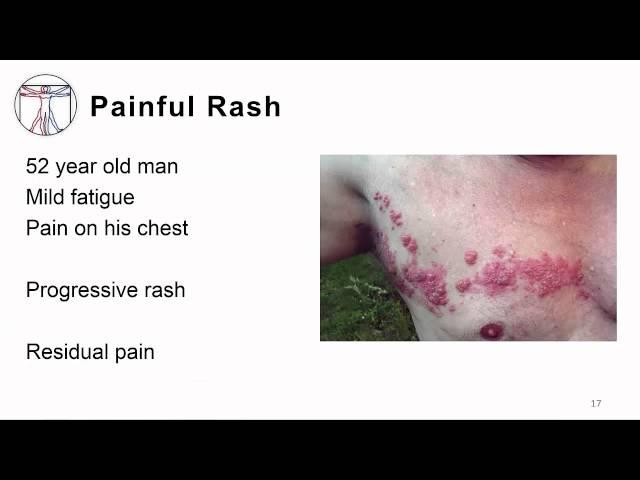 VZV: Pathogenesis & Immune response