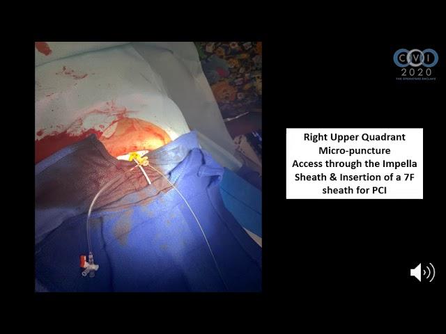 Vascular Access Management During Complex PCI