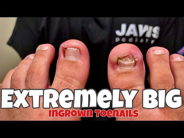 BILATERAL INGROWN TOENAIL