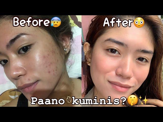 Paano ako Kuminis| How to achieve clear skin | Acne Free| Pimples free |Mavisse Mamba