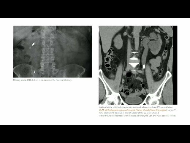 KMLE 강의 시리즈 -  Nephrology, 21) ADPKD, Urinary stone