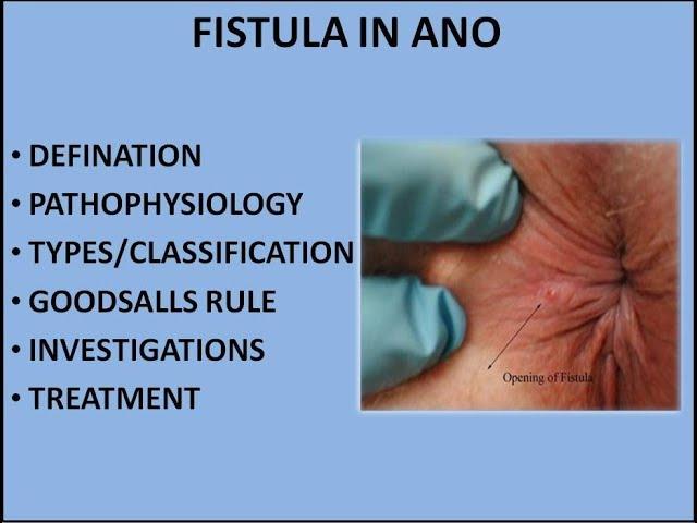 FISTULA IN ANO