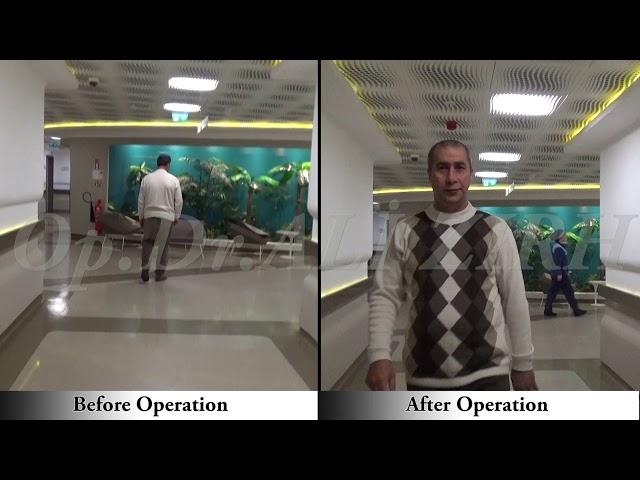 Batdal KURTCU / Before and After Surgery Parkinson's Treatment DBS in Turkey