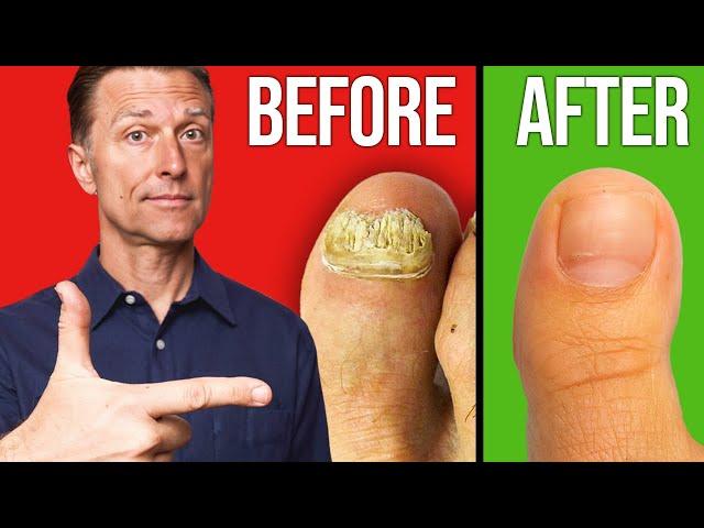 The Fastest Way to Get Rid of Toenail Fungus