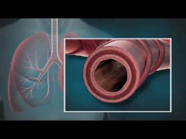 Bronchial Thermoplasty Procedure For Asthma