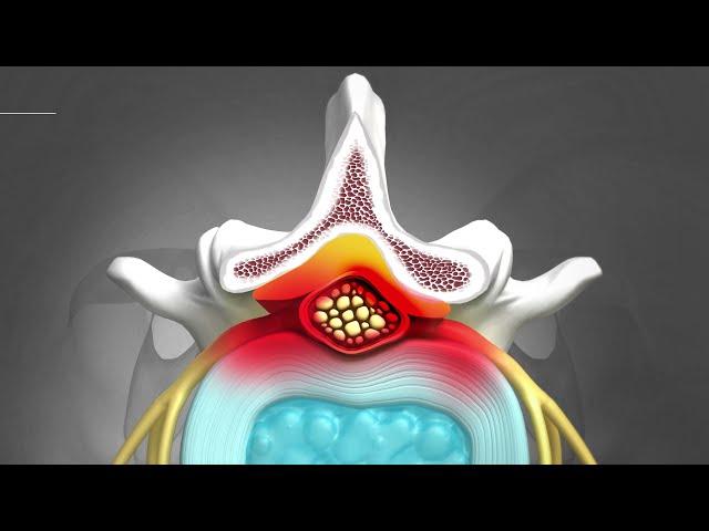 [ENDOVISION SPINE] UBE Spine Endoscopic Surgery 3D Animation