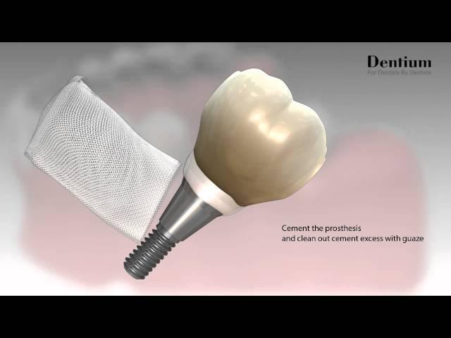 Dentium Prosthesis Procedure