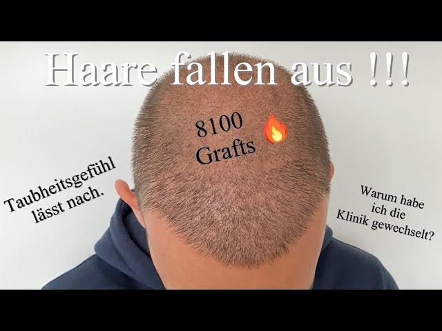 21 Tage nach der Haartransplantation / Warum habe ich die Klinik gewechselt ?