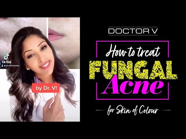 Doctor V - How To Treat Fungal Acne For Skin Of Colour | Brown Or Black Skin | #shorts