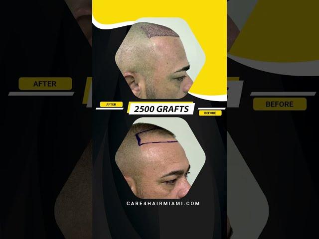 Hair Transplant in our patient. 2500 grafts | Care4Hair