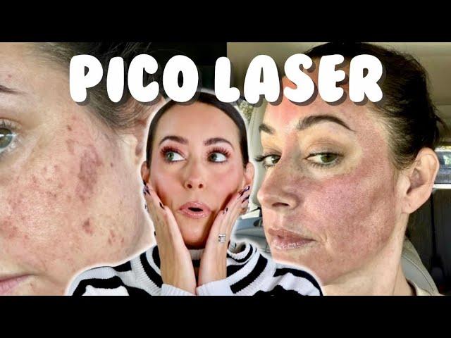 PICO LASER - THE FASTEST WAY TO REMOVE HYPERPIGMENTATION? Everything You Need to Know + Pros & Cons