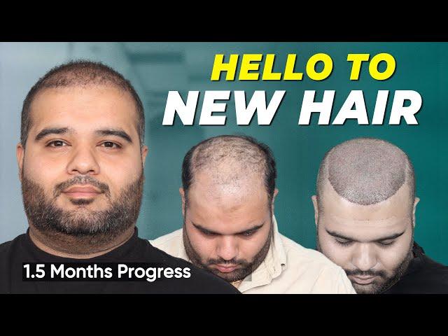 Hair Transplant in Jaipur | Best Results & Cost of Hair Transplant in Jaipur