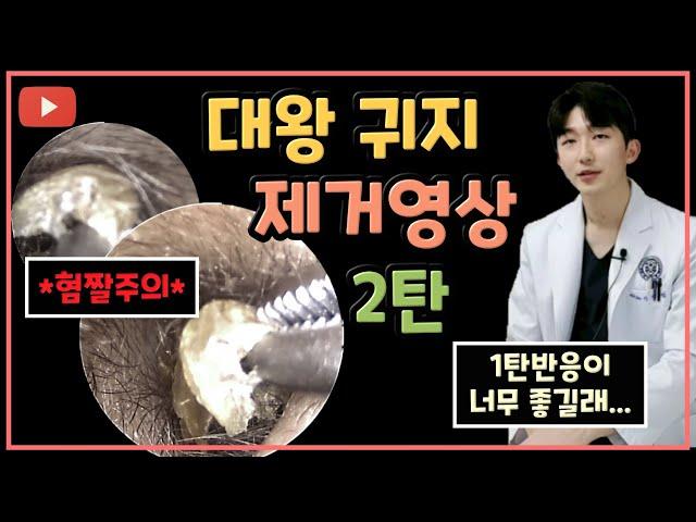 귀지/귓밥/귀똥 제거영상 2탄ㅣ귀파면 안되는 이유 (식사 전에는 보지마세요..)ear wax removal