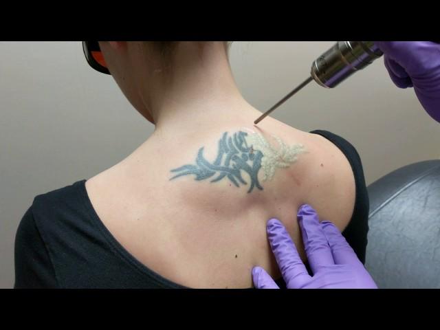 Laser Tattoo Removal | DermMedica