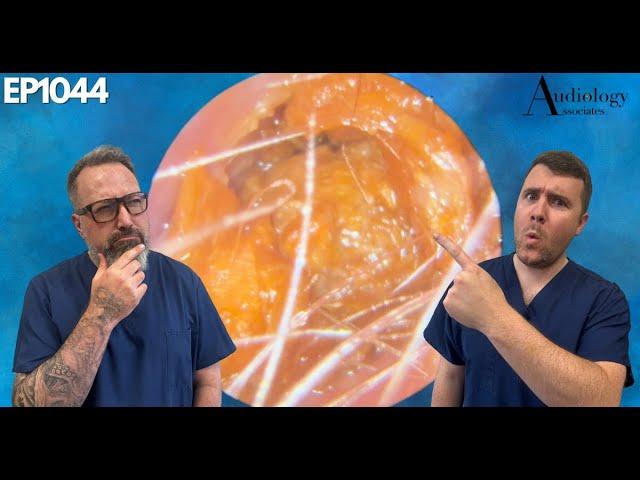 TAYLOR'S MOST DIFFICULT EAR WAX REMOVAL CHALLENGE EVER - EP1044