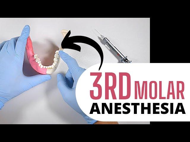 AN EFFECTIVE APPROACH TO BOOSTING THIRD MOLAR ANESTHESIA | OnlineExodontia.com