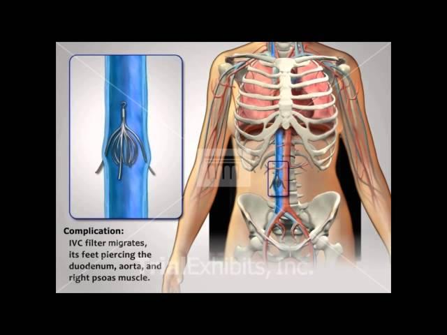 IVC Filter Complications - Medical Animation