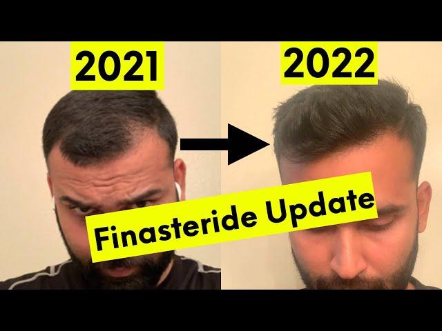 Finasteride 16 Months Update | Hair Regrowth | Side Effects | Hair Vigyan