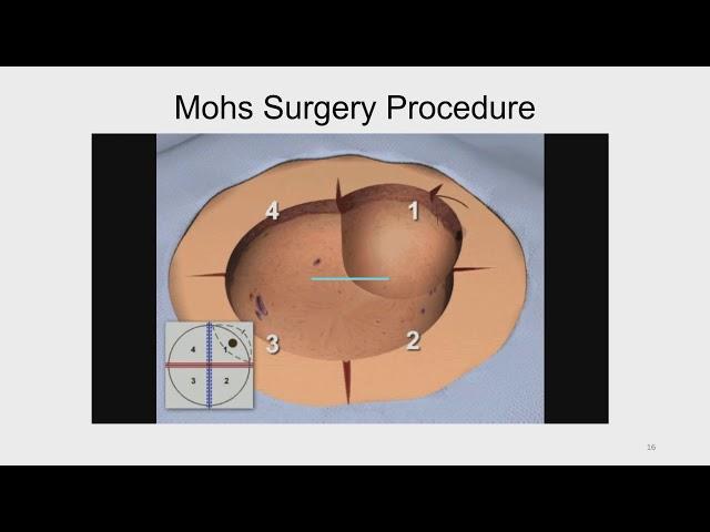 Mohs Micrographic Technique -  An Overview