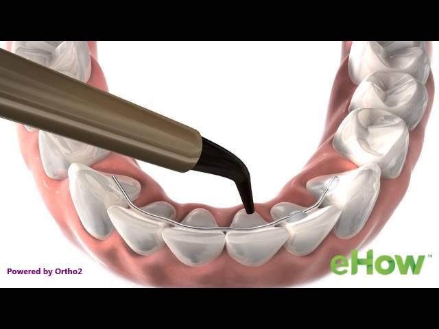 Permanent Retainer