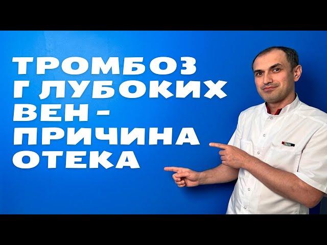 Как заподозрить тромбоз глубоких вен. Флеболог Москва.