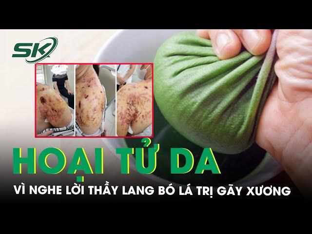 Hoại tử da  vì nghe lời thầy lang bó lá trị gãy xương | SKĐS