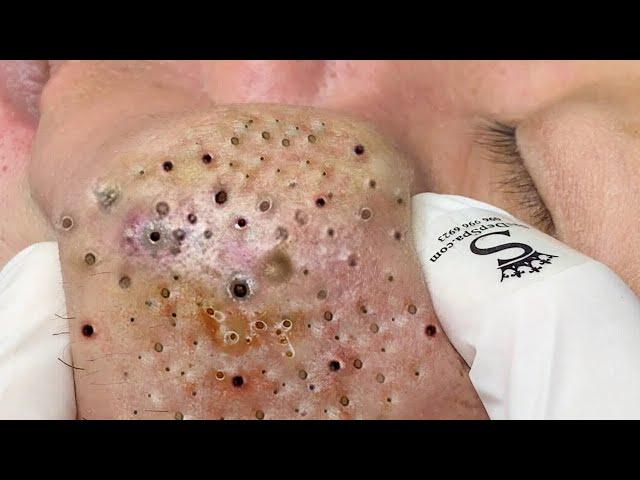 Big Cystic Acne Blackheads Extraction Blackheads & Milia, Whiteheads Removal Pimple Popping # 4589