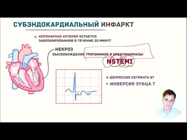 ЭКГ за 100 минут №7: Ишемия и Инфаркт на ЭКГ