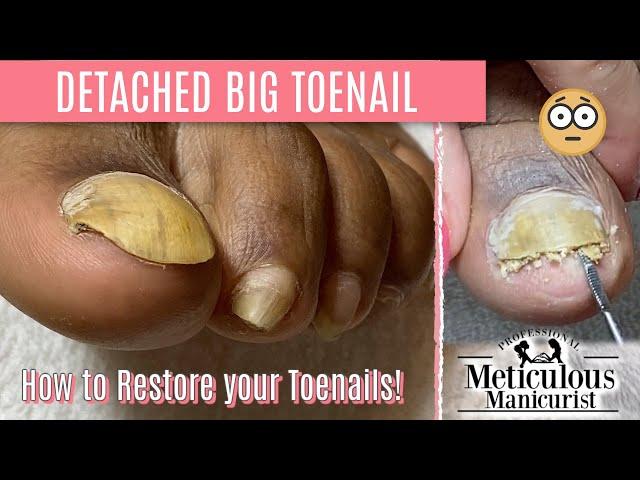 How To Pedicure Transformation for Men on Detached Toenails