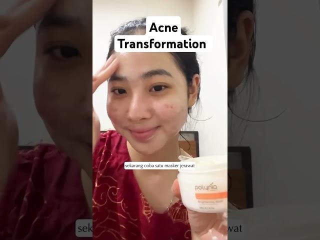 Acne journey credit: polynia.id via IG #acne #acne treatment #acnejourney #pimples