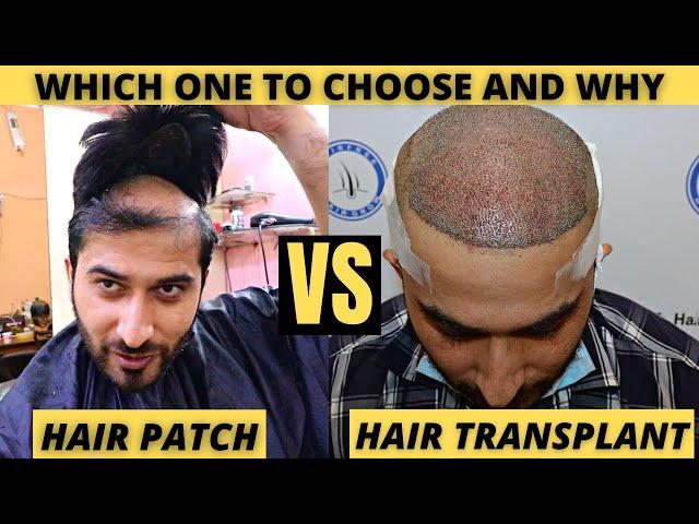 Hair Transplant Vs Hair Patch | Which one you should consider | Born Creator