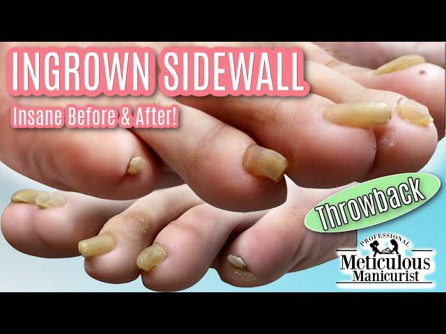 Pedicure Tutorial: How to Cut Long Curled Trumpet Toenails - Throwback