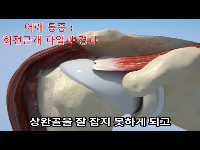 어깨 회전근개 파열과 충돌증후군의 진단과 경과 Diagnosis & Progression of Rotator Cuff Tears & Impingement Syndrome