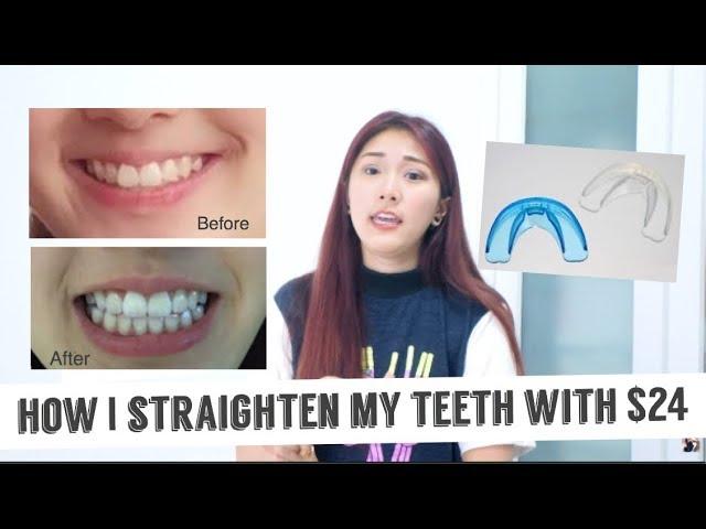 How I straighten my teeth with only $24 (Really effective)