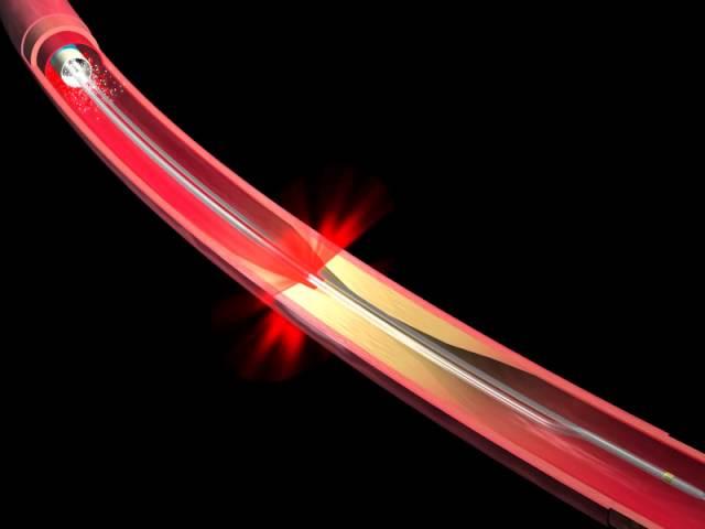 Optical Coherence Tomography Animation