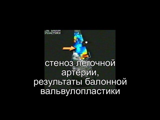 Стеноз легочной артерии, результаты балонной вальвулопластики, эхокардиографическое наблюдение.