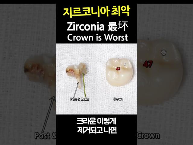 Zirconia Crowns are THE WORST. Get Composite Fillings instead of Crowns on Teeth w/ Root Canals