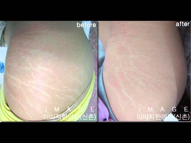 영화배우의 허벅지, 튼살, 핫팬츠, 후산한의원, st침, 튼살침 치료, stretchmark, 양악수술, 하지, 패인 튼살, 성형수술, 진피복원, 출산후 튼살, 배튼살, 종아리튼살