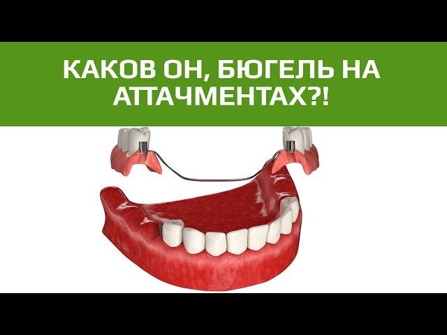 Бюгельные протезы: бюгельный протез на аттачментах или замках