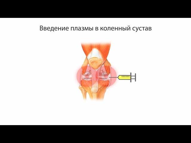 Плазмолифтинг коленного сустава