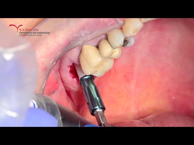 Zirconia Two Pieces Immediate Implant Placement (Tav Dental) with Osseodensification (Densah)